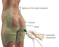 Quelles sont les différentes techniques de liposuccion ?